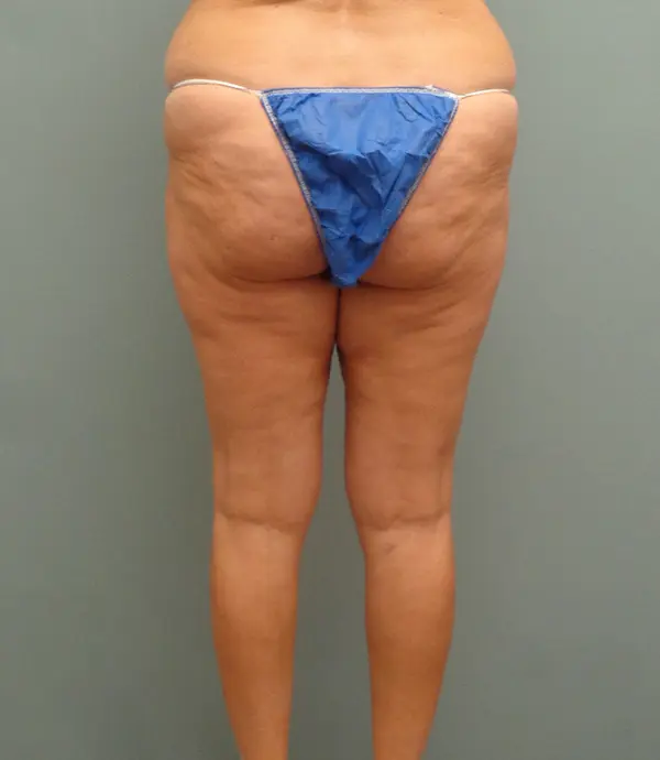 Thigh Lift Before and After Pictures Nashville, TN