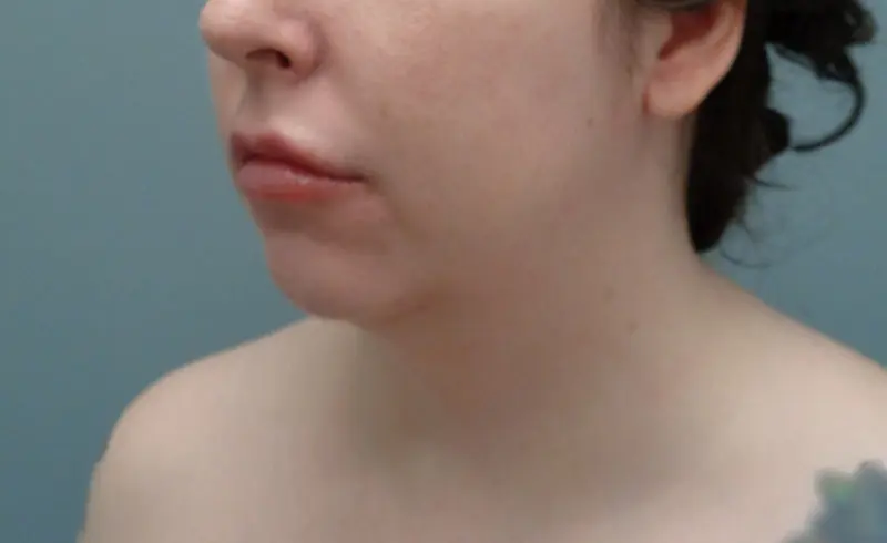 Chin Augmentation Before & After Pictures Nashville, TN