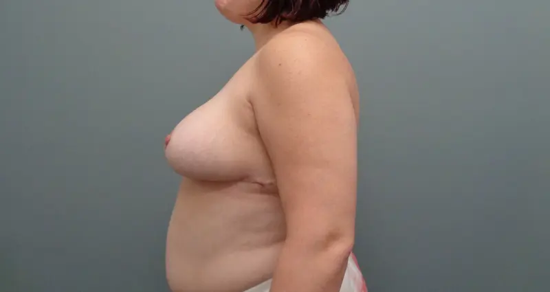 Breast Reduction Before & After Pictures Nashville, TN