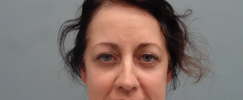 Blepharoplasty Before and After Pictures Nashville, TN
