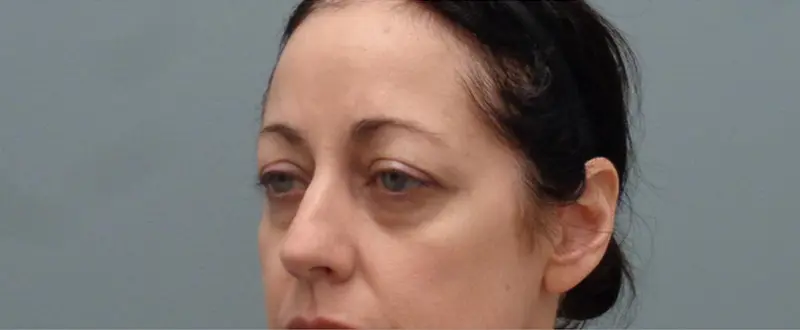 Blepharoplasty Before and After Pictures Nashville, TN