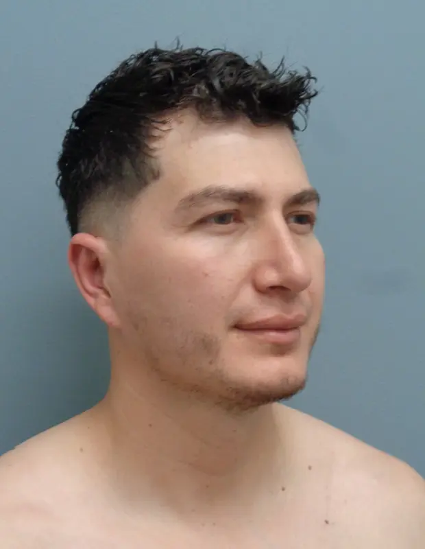 Rhinoplasty Before and After Pictures Nashville, TN