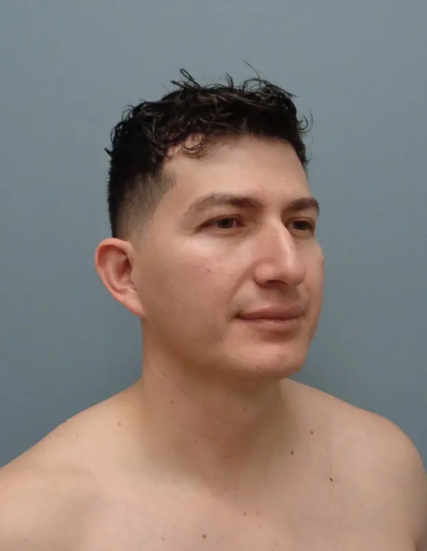 Rhinoplasty Before and After Pictures Nashville, TN