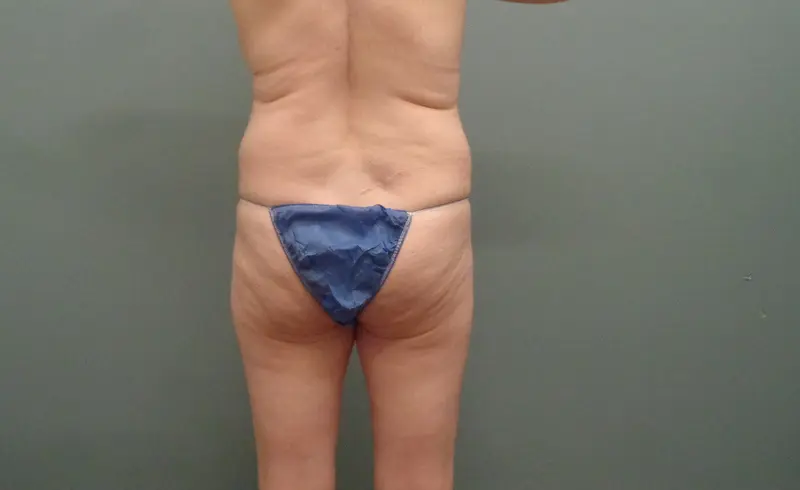 Body Lift Before & After Pictures Nashville, TN