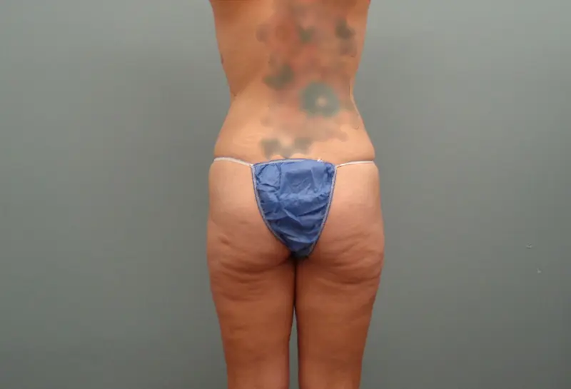 Butt Augmentation Before And After Pictures In Nashville, TN