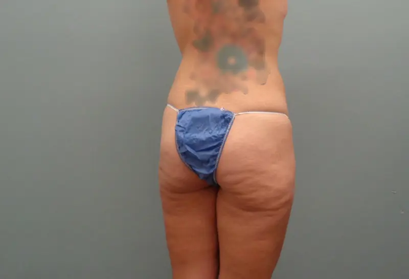 Butt Augmentation Before And After Pictures In Nashville, TN