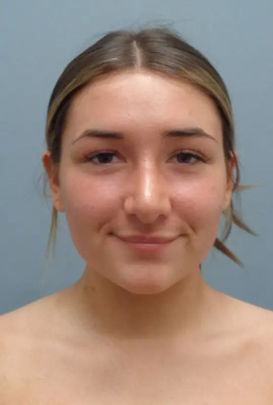 Rhinoplasty Before and After Pictures Nashville, TN