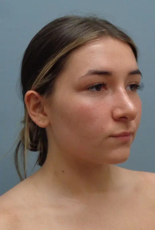 Rhinoplasty Before and After Pictures Nashville, TN