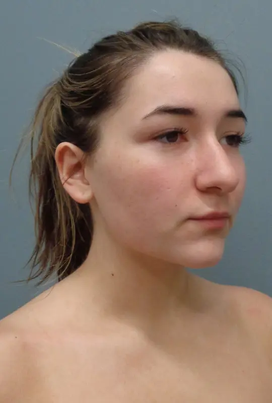 Rhinoplasty Before and After Pictures Nashville, TN