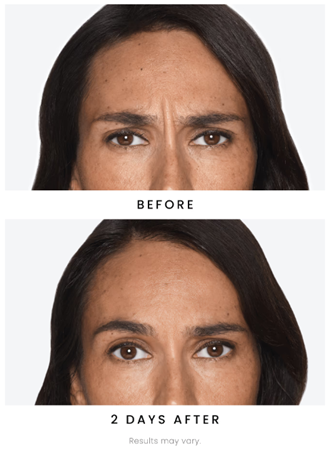 DAXXIFY®-before-and-after