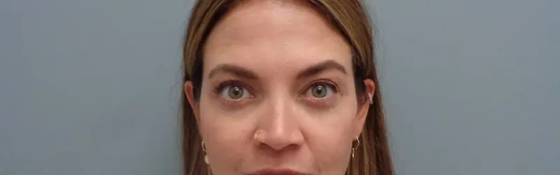 BLEPHAROPLASTY BEFORE & AFTER PICTURES IN NASHVILLE, TN