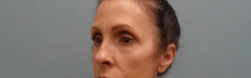 Blepharoplasty Before & After Pictures in Nashville, TN