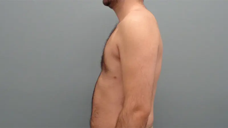 Gynecomastia Before & After Pictures Nashville, TN