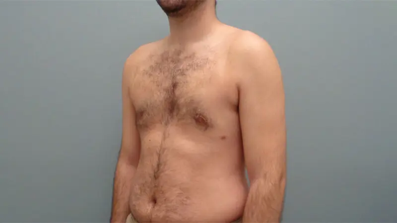 Gynecomastia Before & After Pictures Nashville, TN