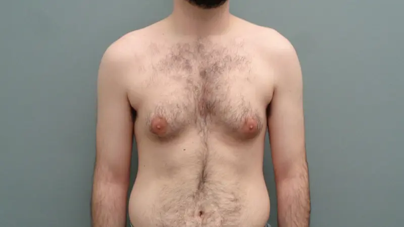 Gynecomastia Before & After Pictures Nashville, TN