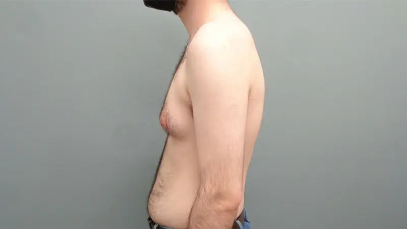 Gynecomastia Before & After Pictures Nashville, TN