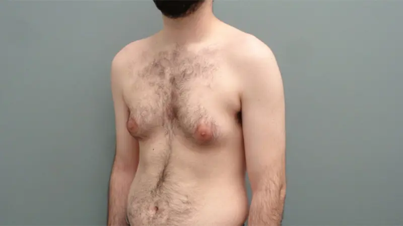 Gynecomastia Before & After Pictures Nashville, TN
