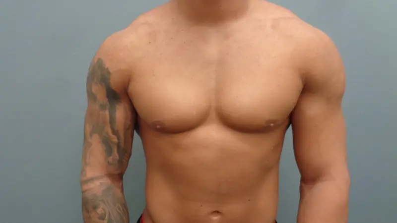 Gynecomastia Before & After Pictures in Nashville, TN