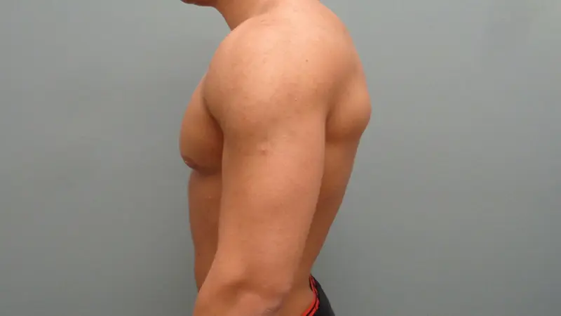 Gynecomastia Before & After Pictures in Nashville, TN