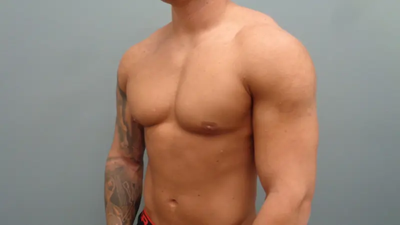 Gynecomastia Before & After Pictures in Nashville, TN
