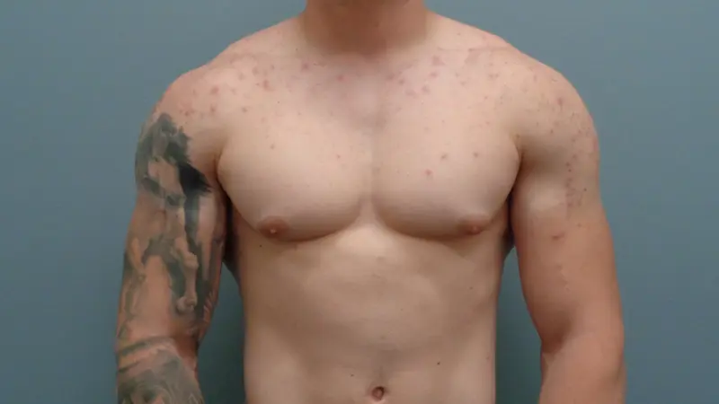 Gynecomastia Before & After Pictures in Nashville, TN