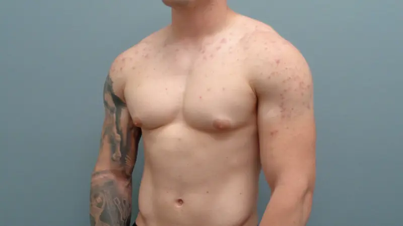 Gynecomastia Before & After Pictures in Nashville, TN
