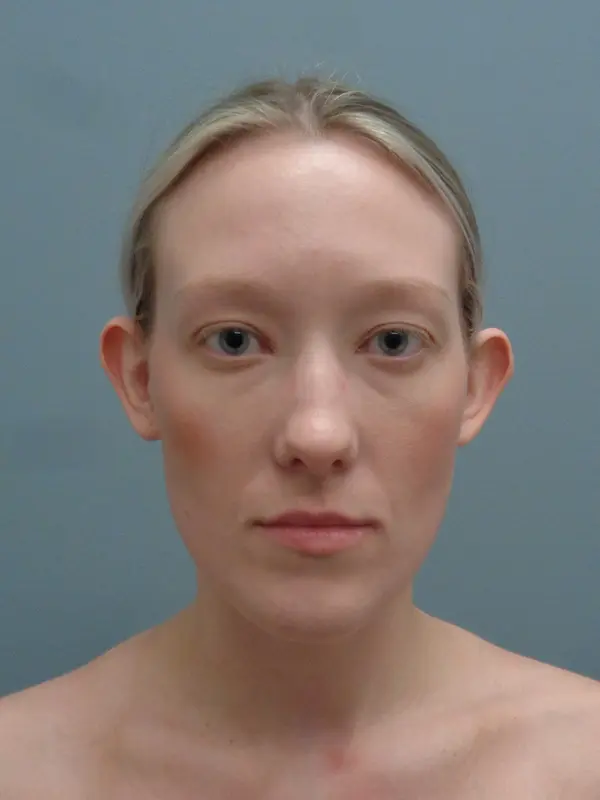Otoplasty Before and After Pictures Nashville, TN