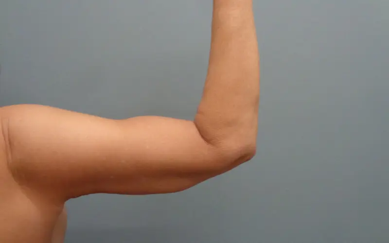 Arm Lift Before and After Pictures Nashville, TN