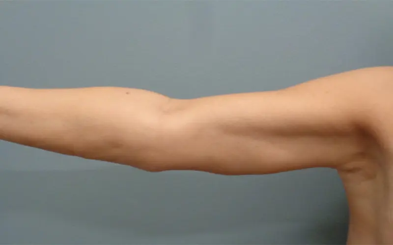 Arm Lift Before and After Pictures Nashville, TN