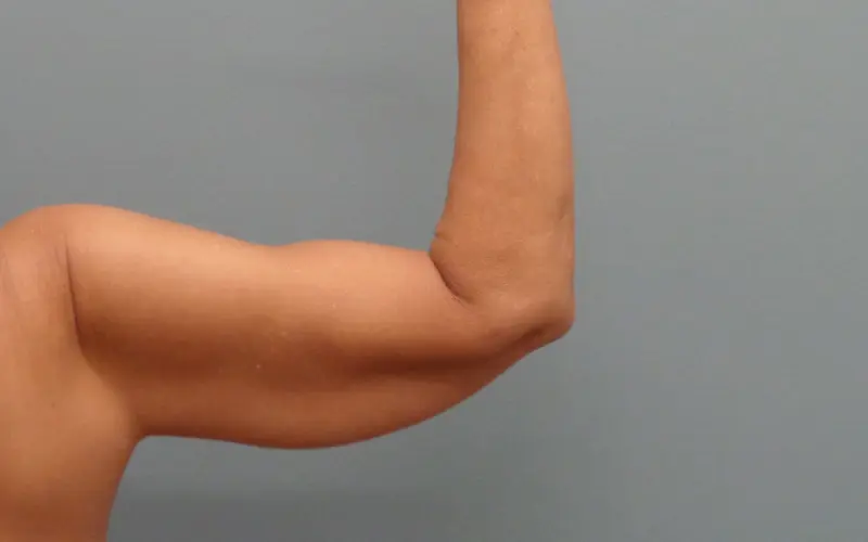 Arm Lift Before and After Pictures Nashville, TN