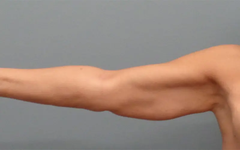 Arm Lift Before and After Pictures Nashville, TN