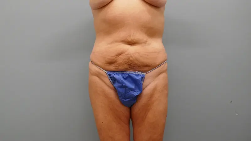 Tummy Tuck Before and After Pictures Nashville, TN