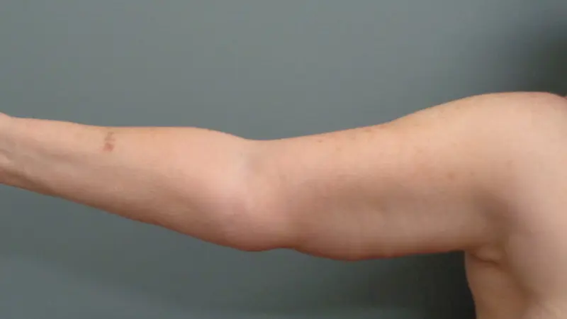 Arm Lift Before & After Pictures Nashville, TN