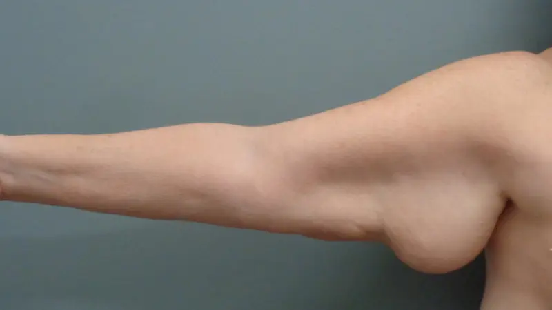 Arm Lift Before & After Pictures Nashville, TN