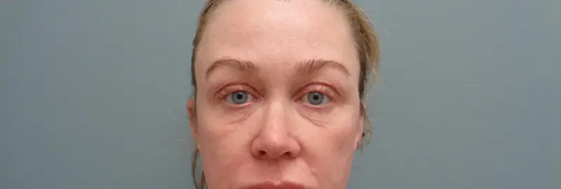 BLEPHAROPLASTY BEFORE & AFTER PICTURES IN NASHVILLE, TN
