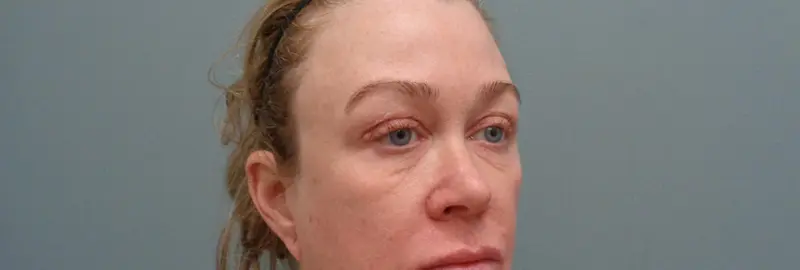 BLEPHAROPLASTY BEFORE & AFTER PICTURES IN NASHVILLE, TN