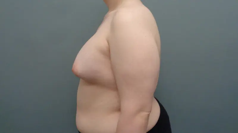 Breast Augmentation Before & After Pictures in Nashville, TN