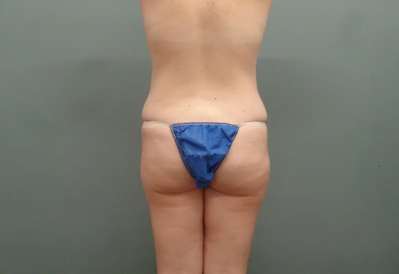 Butt Augmentation Before and After Pictures Nashville, TN