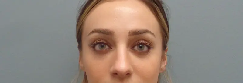 Blepharoplasty Before & After Pictures in Nashville, TN