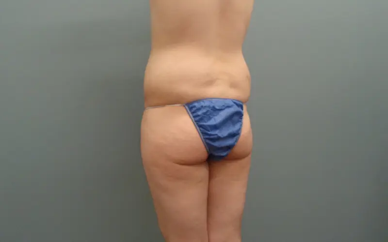 Butt Augmentation Before And After Pictures Nashville, TN