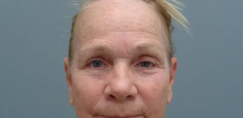 Brow Lift Before & After Pictures in Nashville, TN