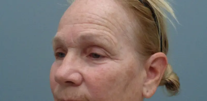 Brow Lift Before & After Pictures in Nashville, TN