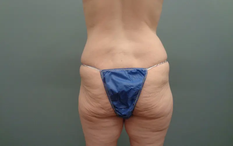 Butt Augmentation Before and After Pictures Nashville, TN