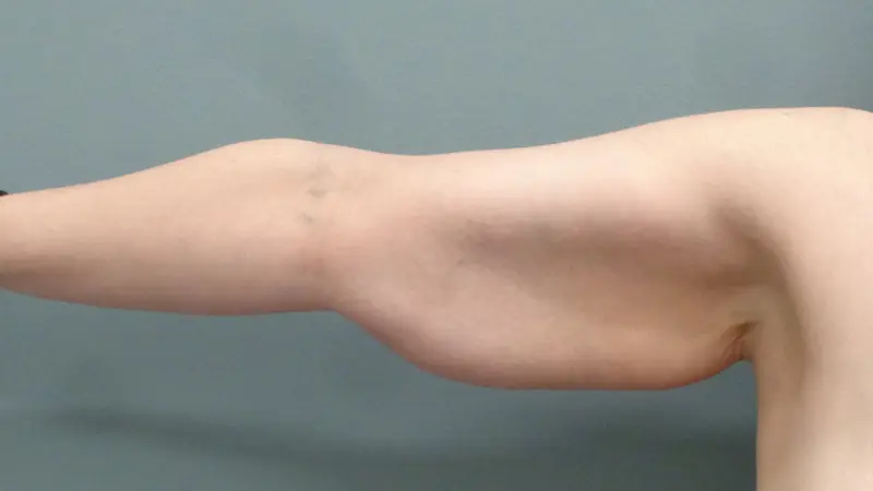Arm Lift Before & After Pictures Nashville, TN