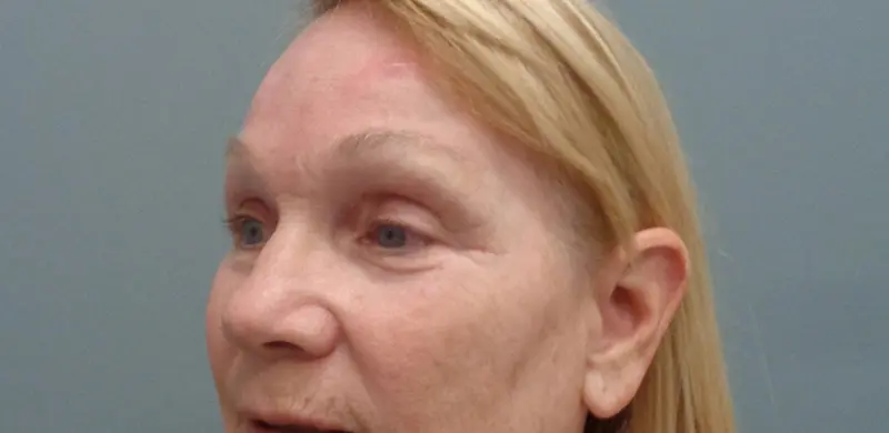 Brow Lift Before & After Pictures in Nashville, TN