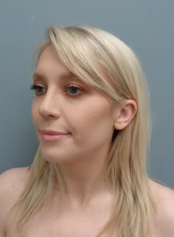 Rhinoplasty Before & After Pictures Nashville, TN