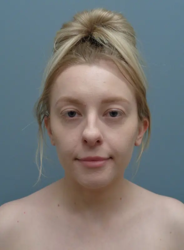Rhinoplasty Before & After Pictures Nashville, TN