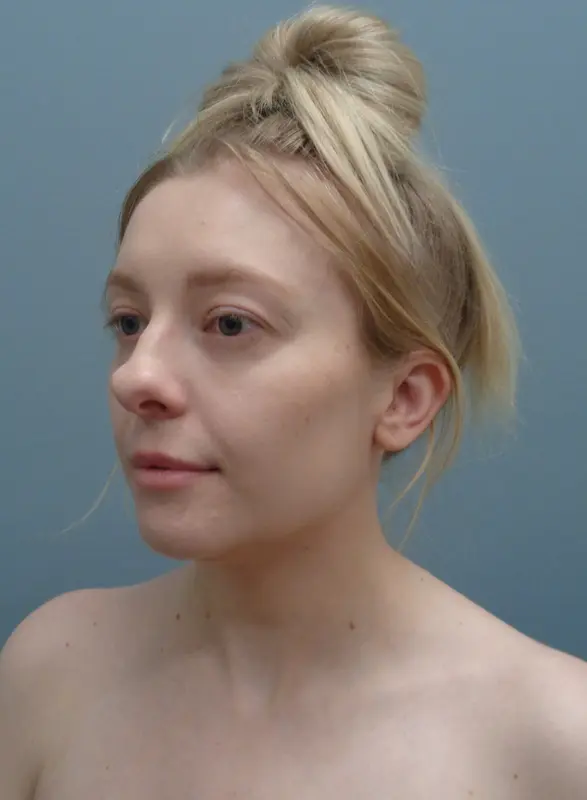Rhinoplasty Before & After Pictures Nashville, TN