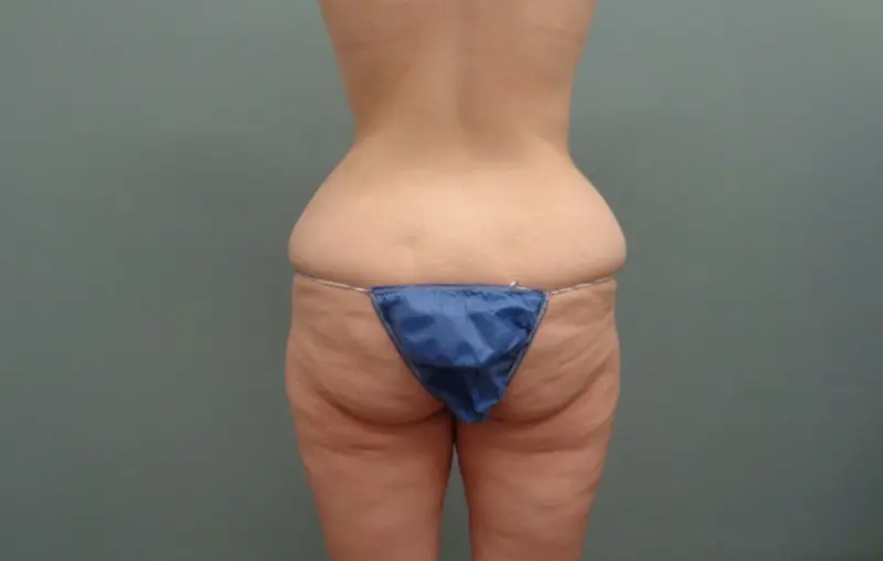 Body Lift Before & After Pictures Nashville, TN