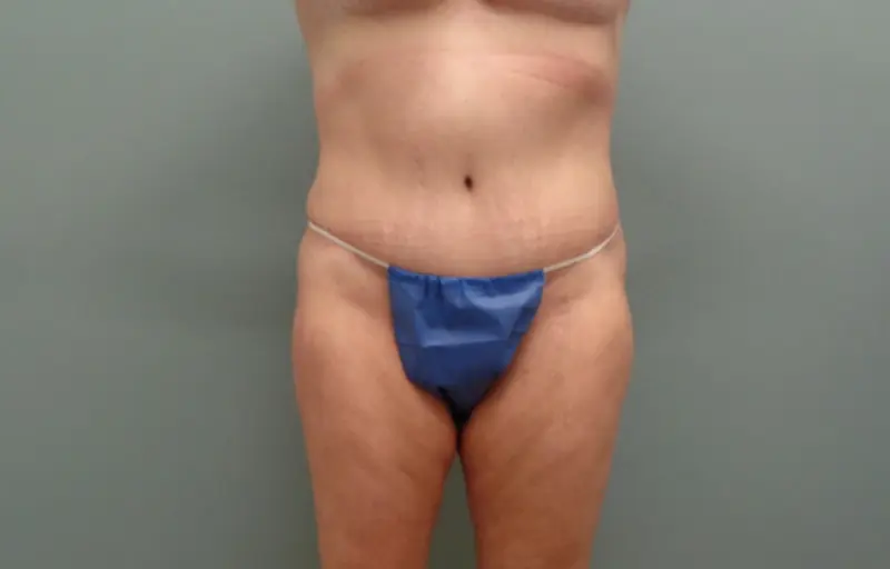 Before & After Pictures in Nashville, TN